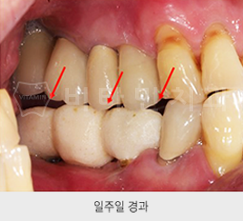 신도림 임플란트 치과