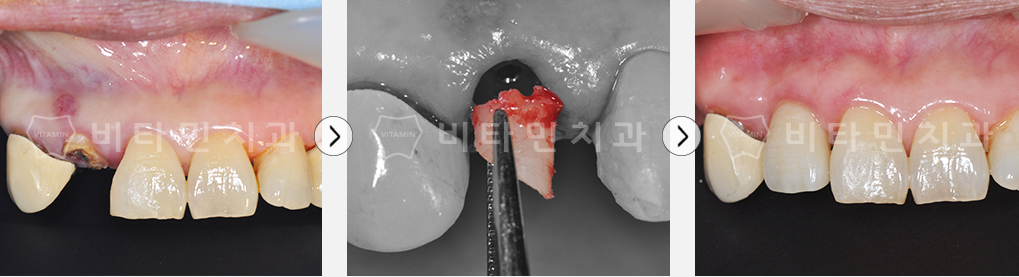 뼈이식 임플란트 하는 치과