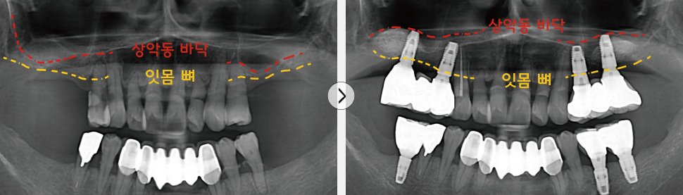상악동거상술 임플란트